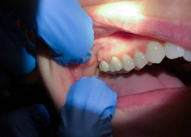Best Dentist for Tooth Abscess  in Freeport, TX